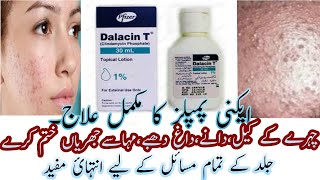 Best Acne Lotion  Dalacin T Lotion  Calindamycin 1 Acne Lotion Review In Urdu Hindi [upl. by Ennairb]