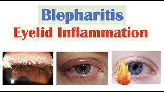 Blepharitis Eyelid Inflammation  Causes Risk Factors Signs amp Symptoms Diagnosis Treatment [upl. by Andriette741]