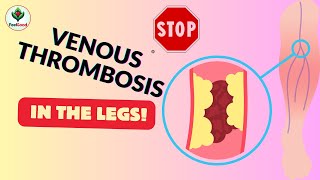 Warning Signs Deep Vein Thrombosis [upl. by Meagher98]