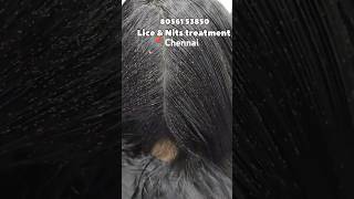 Nits lice treatment 💯 result Chennai amp doorstep available headlicetreatmentheadliceheadshotlice [upl. by Ahsilyt]