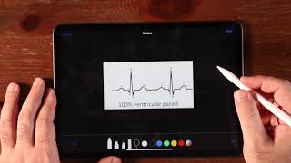 NCLEX 101  Pacemaker Rhythm on ECG [upl. by Trygve]