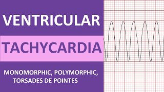 Ventricular Tachycardia Vtach ECG Interpretation Treatment Nursing NCLEX Review [upl. by Edgell]