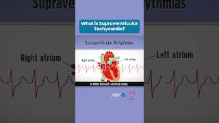 What is Supraventricular Tachycardia [upl. by Chris]