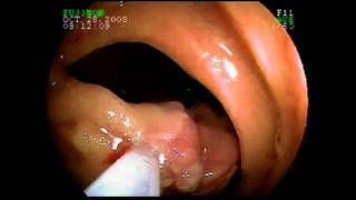 Using Capsule Endoscopy and Double Balloon Enteroscopy for Complex Small Intestinal Disease [upl. by Prent]