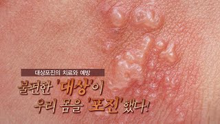 TV메디컬 약손대상포진경북대병원 마취통증의학과 김세영교수 [upl. by Julie]