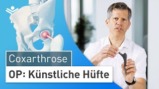 Hüftprothese Künstliches Hüftgelenk durch minimalinvasive Operation  HüftTEP [upl. by Anayia]