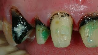 Problems with crown or veneer cementing Ask the Pros [upl. by Ieppet]