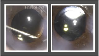 A simple way to perform surgical iridectomy with a 26G needle and a Sinskeys hook during Phaco [upl. by Garv23]