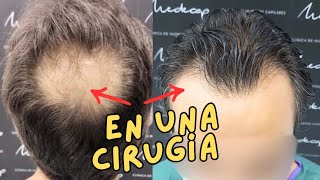 👨‍🦲➡️👨 ¡Espectacular Trasplante Capilar Frontal y Coronilla en una Cirugía Antes y Después 🌟 [upl. by Gretta]