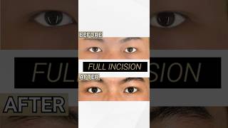 3 main methods to create asian blepharoplasty [upl. by Pride200]