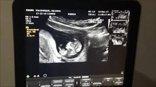 Nuestro bebe de 3 meses Ultrasonido [upl. by Mackenie716]