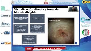 DR CARLOS ALBERTO SALDIVAR RODEA  COLANGIOSCOPÍA EN EL DIAGNÓSTICO CLASIFICACIÓN Y TRATAMIENTO [upl. by Vere]