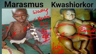 Protein Energy Malnutrition Biochemistry  Marasmus Vs Kwashiorkor  Kwashiorkor  Marasmus [upl. by Otiv]