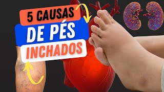 5 causas de pés inchados [upl. by Meeki]