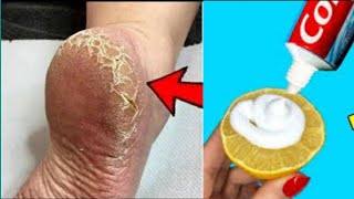 Crack Heel Treatment  Crack Heel Home Remedy  Crack Heel Treatment Tips  Health Tips [upl. by Wobniar103]