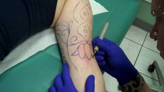 Arm branding at Evolution Body Piercing [upl. by Martine]