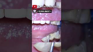 DENTAL CROWNS Patients Request to Make Her Teeth Uniform PART 1 4k dentist [upl. by Karoly]