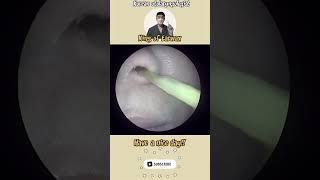 귀지형 콧물 부비동염 축농증 비염 코청소 이비인후과 rhinorrhea rhinitis sinusitis asmr [upl. by Resee]