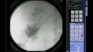 FLUOROSCOPY IN PERCUTANEUS RENAL SURGERY [upl. by Odysseus]