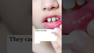 Mouth Ulcers Canker Sore mouthulcer cankersores dentistry oralcare oralhealth dentalhealth [upl. by Haimehen]