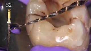 33 ProTaper Gold technique with Dr Gutmann [upl. by Eatnuhs418]