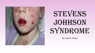 StevensJohnson syndrome [upl. by Barrow]