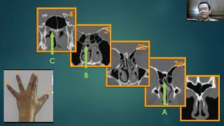 Paranasal Sinuses CT  A map toward safe endoscopic sinus surgery [upl. by Marcelle76]