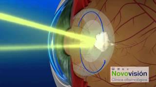 ¿CÓMO FUNCIONA EL LÁSER YAG  CLÍNICAS NOVOVISIÓN [upl. by Iroak]
