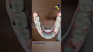 Lower first Premolar Extraction in Class III Malocclusion Correction dentist class3 orthodontics [upl. by Yaral867]