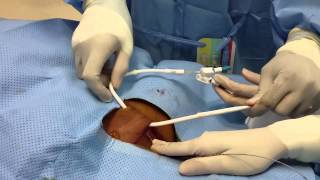 Tunneled Dialysis Catheter Insertion [upl. by Omiseno]