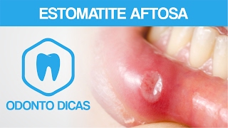 ESTOMATITE AFTOSA  ODONTO DICAS [upl. by Blackstock]