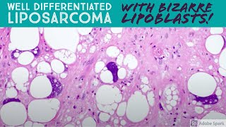 Well differentiated liposarcoma with BIZARRE pleomorphic lipoblasts 5Minute Pathology Pearls [upl. by Courtnay]