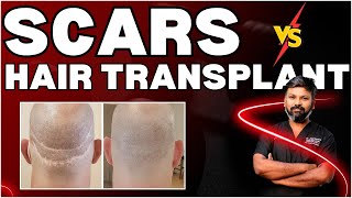 AskDrJohnWatts  SCARS vs HAIR TRANSPLANT  Hair Specialist Explains [upl. by Aikam]