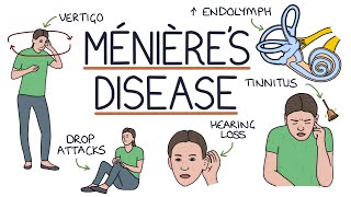 Understanding Ménière’s Disease [upl. by Piks]