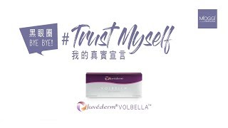 真實用家 真實見證Juvederm® VOLBELLA™豐盈淚溝療程 [upl. by Berners]