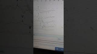 ADHD चाइल्ड hearing Test Normal BERA Recording with hper brain activity [upl. by Grayce101]