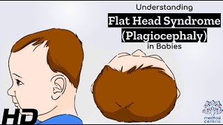 Flat Head Syndrome Explained Causes Symptoms and Solutions [upl. by Ahsinav]