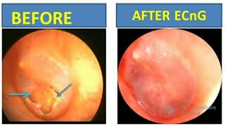 Ear drum perforation hearing loss Tinnitus recovered with in a week of treatment [upl. by Paulson]