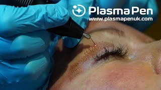 Plasma Pen  Louise Walsh International  Before amp Afters  How We Get These Results [upl. by Harvie740]