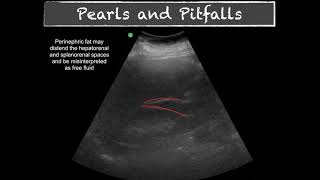 POCUS  E FAST  Pitfalls [upl. by Ellerahs]