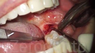 Horizontal Impacted Wisdom Tooth  Sonic Surgery  Dr Fabio Cozzolino  Zerodonto [upl. by Aicilec]