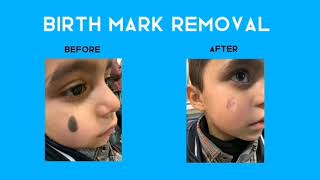 See the Shift Birthmark Removal Journey  Before and After Laser lasertherapy birthmarkremoval [upl. by Tanah991]