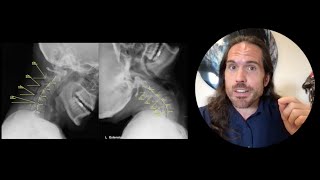 Cervical Instability Dizziness amp Headaches Do I need injections Chiropractor Spokane [upl. by Nilde]