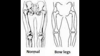 How to Fix bow legs amp Knock knees genu varum Bow Legs surgery  free Remedy  Bowlegs Correction [upl. by Ennaoj]