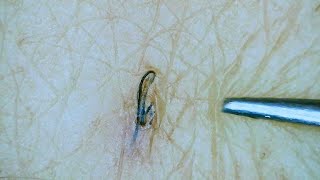 plucking normal and ingrown hairs 9 [upl. by Ttocs]