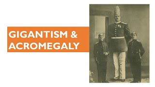 Gigantism amp Acromegaly Well Explained [upl. by Ppik945]