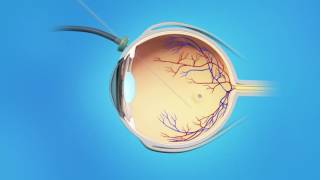 Macular Hole Vitrectomy Surgery [upl. by Ennovi790]