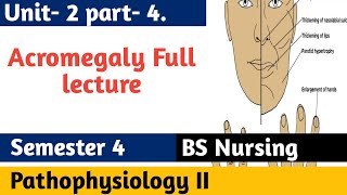 Acromegaly  Growth Hormone Signs amp Symptoms Diagnosis Treatment  Pathophysiology 2 in Urdu [upl. by Daphna745]