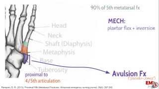 5th Metatarsal Fractures [upl. by Erehc]