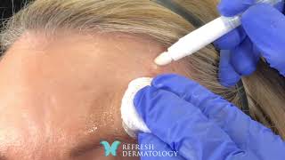 Eskata Live Demonstration to remove a Seborrheic Keratosis [upl. by Ahsenrad]